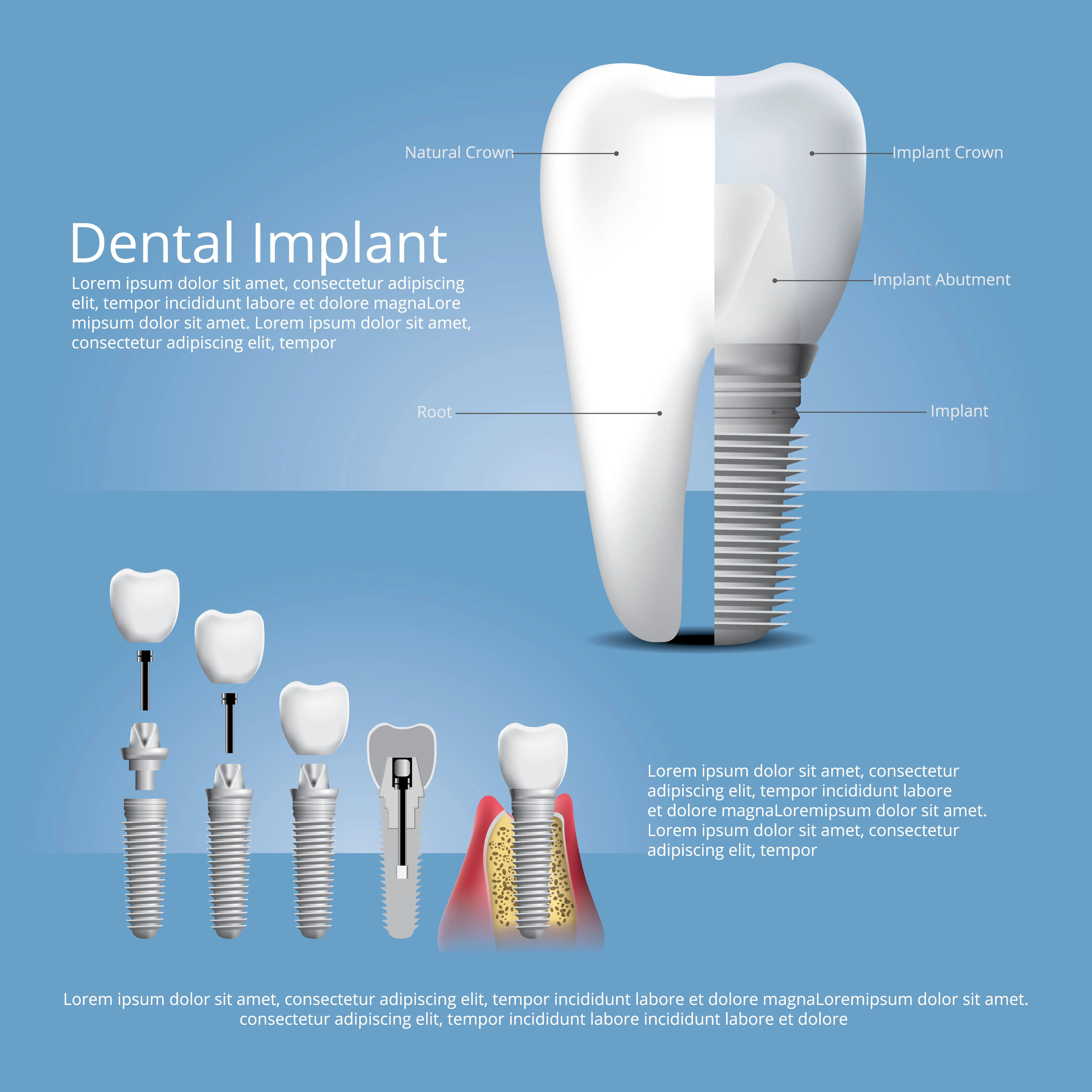 Dental Implant Procedure